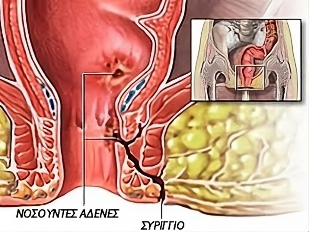 Περιεδρικό Συρίγγιο Κόστος 1