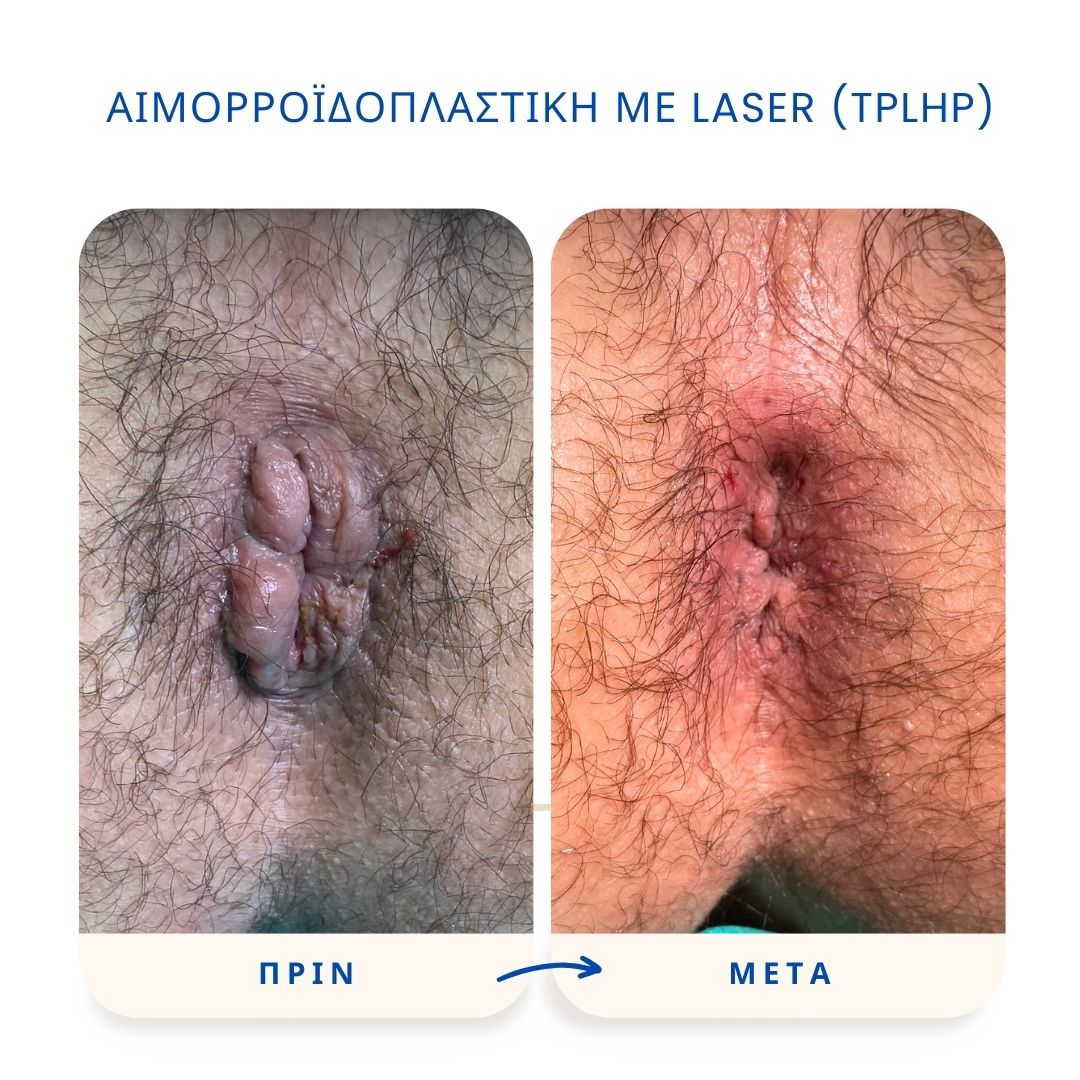 Αιμορροΐδες & Χρόνια Δυσκοιλιότητα 1